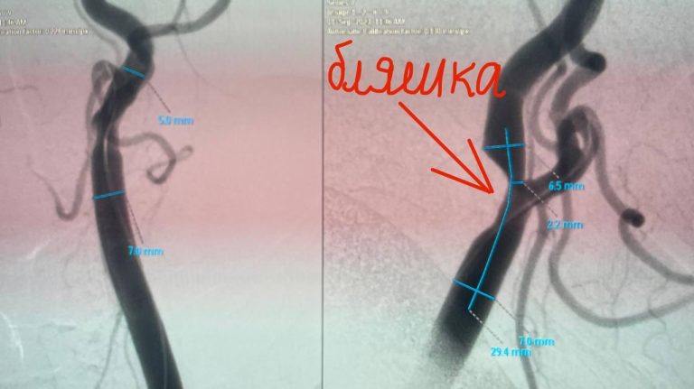 Современные методы профилактики инсульта